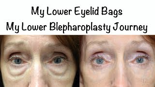 My Lower Eyelid Bags My lower blepharoplasty journeyrecovery story with photos [upl. by Phelia524]