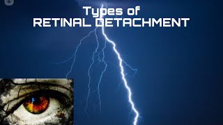 8 Types of Retinal Detachment RETINAL DETACHMENT retinaldetachment [upl. by Shewmaker115]