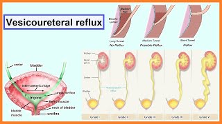 vesicoureteral reflux [upl. by Rep]