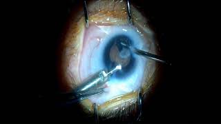 lensectomy proceduremicrocornea cataract surgerymicrophthalmiacoloboma of eye [upl. by Skeie]