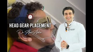 Head gear placement in orthodontics facebow high pullactivator in class II skeletal Dr Amr Asker [upl. by Eimaraj298]