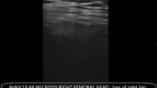 CASE 456 ultrasound avascular necrosis femoral head [upl. by Hendry854]