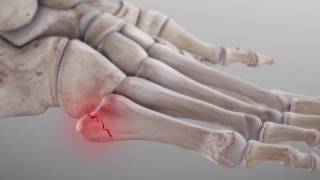 Metatarsal Fractures  Complete Anatomy [upl. by Stephenson]