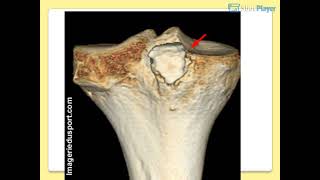 OSTEOLOGIE DU MEMBRE INFERIEUR [upl. by Duax]