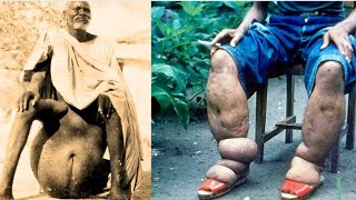 The HORRIFYING History of Elephantiasis [upl. by Ebonee]