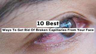 10 Best Ways To Get Rid Of Broken Capillaries From Your Face [upl. by Nesyla]