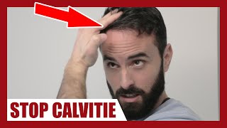 CALVITIE  Comment appliquer correctement le MINOXIDIL afin de la stopper [upl. by Kenweigh]