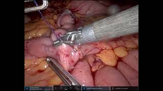 Robotic ileocolic intracorporeal anastomosis  Unedited  Right Hemicolectomy [upl. by Gathard]