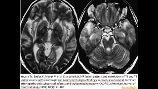 70 CADASIL Notch3 arteriopathy pericyt blood brain barrier anterior temporal pole stroke [upl. by Enileuqcaj]