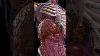 Cirrhosis Liver Under Siege 3dmodel meded anatomy [upl. by Lightfoot]