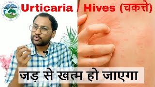 Homeopathic medicine for urticaria skin rash  skin allergy खुजली जलन चकत्ते [upl. by Tullus947]