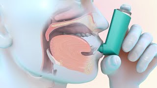 Inhaler and Nebuliser Explanation  Asthma [upl. by Maryann274]