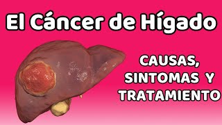 CÁNCER DE HÍGADO Causas signos y síntomas diagnóstico y tratamiento [upl. by Ajaj387]