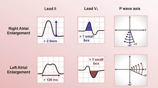 Intro to EKG Interpretation  Chamber Enlargement [upl. by Rossing891]