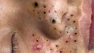 Big Cystic Acne Blackheads Extraction Blackheads amp Milia Whiteheads Removal Pimple Popping  353 [upl. by Pedersen]