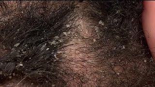 Dandruff Picking and Scratching  Flaky Eczema Scalp extreme close up ASMR [upl. by Ahtis]