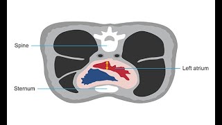 Assessing the left atrium using 3D echocardiography [upl. by Yrot]