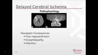 Monitoring for Delayed Cerebral Ischemia following Subarachnoid Hemorrhage Webinar English [upl. by Ordnasil]