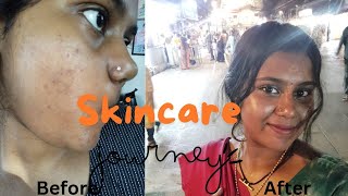 MY SKINCARE TRANSFORMATION🌷PHARMACY PRODUCTS👀Clinmiskinahaglow [upl. by Ibok13]