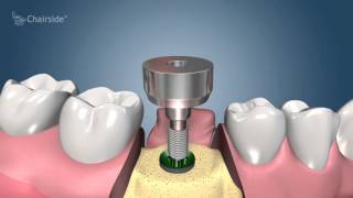 Dental Implant Procedure  Two Stage 🦷 Award Winning Patient Education [upl. by Kciderf390]