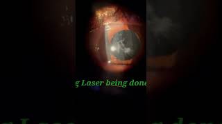 YAG LASER capsulotomy in PCO [upl. by Lieno83]