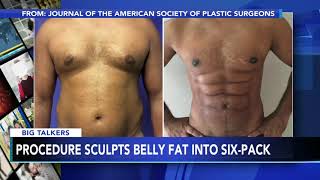 New procedure uses foam to sculpt belly fat into 6pack abs [upl. by Ahsieken317]