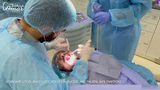 Autotransplantation of mature 3rd Molar [upl. by Onitrof]