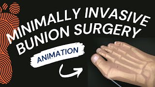 Minimally Invasive Bunion Surgery A Short Animation [upl. by Namron566]