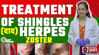 Shingles Herpes Zoster Pathophysiology Risk Factors Phases of Infection Symptoms Treatment [upl. by Dobbins]