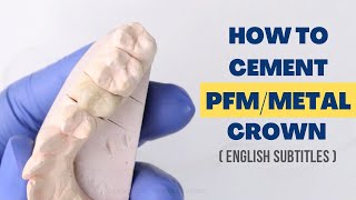 How to Cement a PFMMetal Crown [upl. by Doomham]