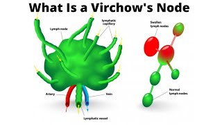 What Is a Virchows Node [upl. by Eednam]