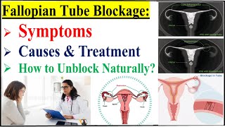 Fallopian Tube Blockage Symptoms Causes Diagnosis amp TreatmentHow To Open Blocked Fallopian Tubes [upl. by Iluj319]