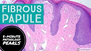 Fibrous Papule Angiofibroma 5Minute Pathology Pearls [upl. by Fernandes]