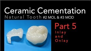 Lithium Disilicate Ceramics Part 5 Cementation of Inlay and Onlay [upl. by Inek]