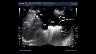 Ultrasound Video showing multiple adhesions in between the gut loops [upl. by Notsirb]