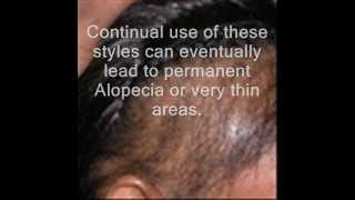 Possible Balding Hair Loss Cure [upl. by Lamiv]