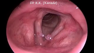 Video Laryngoscopy  How Vocal Polyp Look Like [upl. by Mable]