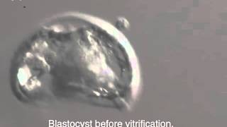 INSTITUT MARQUÈS  Frozen embryos vitrified blastocyst [upl. by Animas]