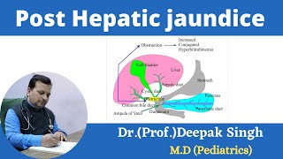 Post Hepatic jaundice  Obstructive jaundice  Deepak PD Singh [upl. by Marybelle]