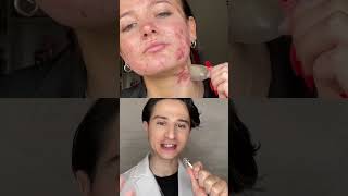 Pimple Patch Secret dermreacts acne skincare [upl. by Ermentrude]