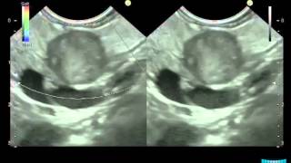 EUS in Solid Pancreatic Lesions Detection Characterization amp Assessment of Resectability [upl. by Lipson]