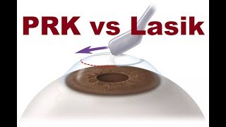 PRK VS Lasik Hindi [upl. by Aratas760]