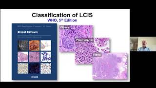 HighRisk Breast Lesions and Breast Cancer [upl. by Nannerb]