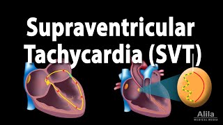 Supraventricular Tachycardia SVT PSVT Animation [upl. by Mima]