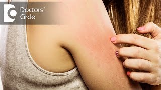 5 Top Causes of Itchy skin  Dr Urmila Nischal [upl. by Damiani944]