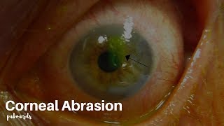 Eye injuries Corneal abrasion [upl. by Regdor]