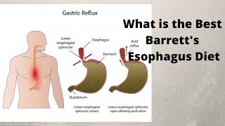 What is the Best Barretts Esophagus Diet [upl. by Shoemaker364]