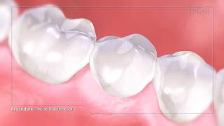 Conventional Dental Bridge [upl. by Legnaesoj]