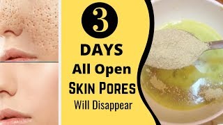 3 Days and All Open Pores Will Disappear from Your Skin Forever [upl. by Tfat640]