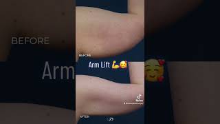 Amazing Arm Lift BEFORE and AFTER  Los Angeles CA [upl. by Lopez181]